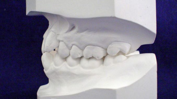 implantater